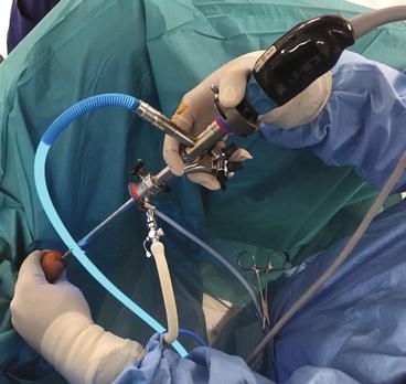 جراحی آندوسکوپی کلیه در مشهد
