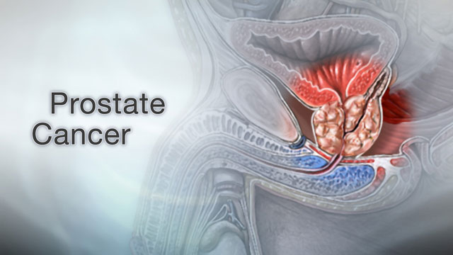 What is prostatectomy surgery?